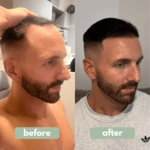 Reverse - Hair Growth Serum
